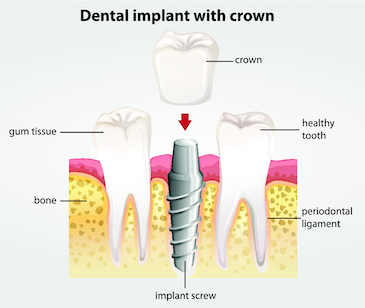 dental implant fairfax va